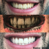 Charcoal Teeth Whitening